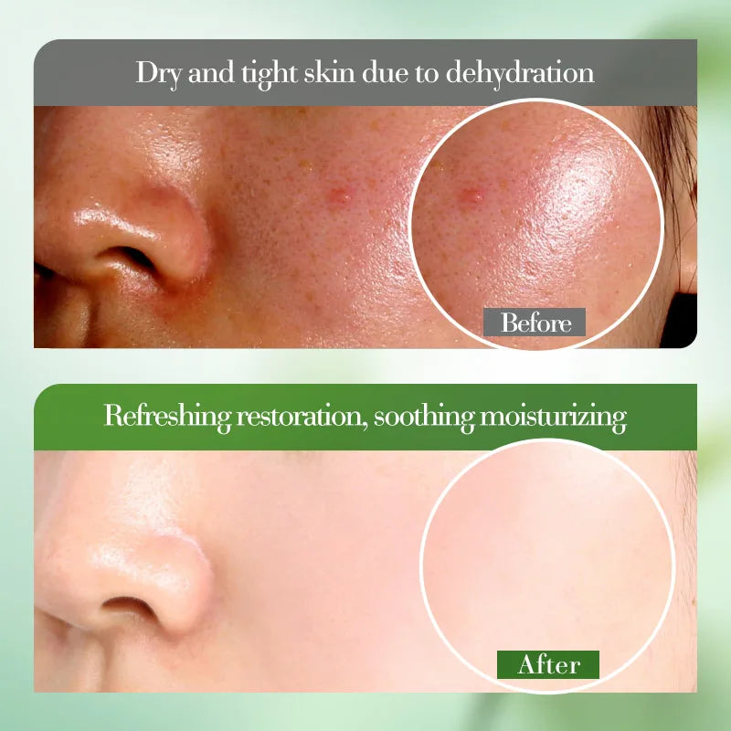 Aloe Vera Gel 100% Natural For Face And Body, Hydrating Moisturizing  Soothing Skin For Sunburn Relief, Acne, After Sun Care 50g